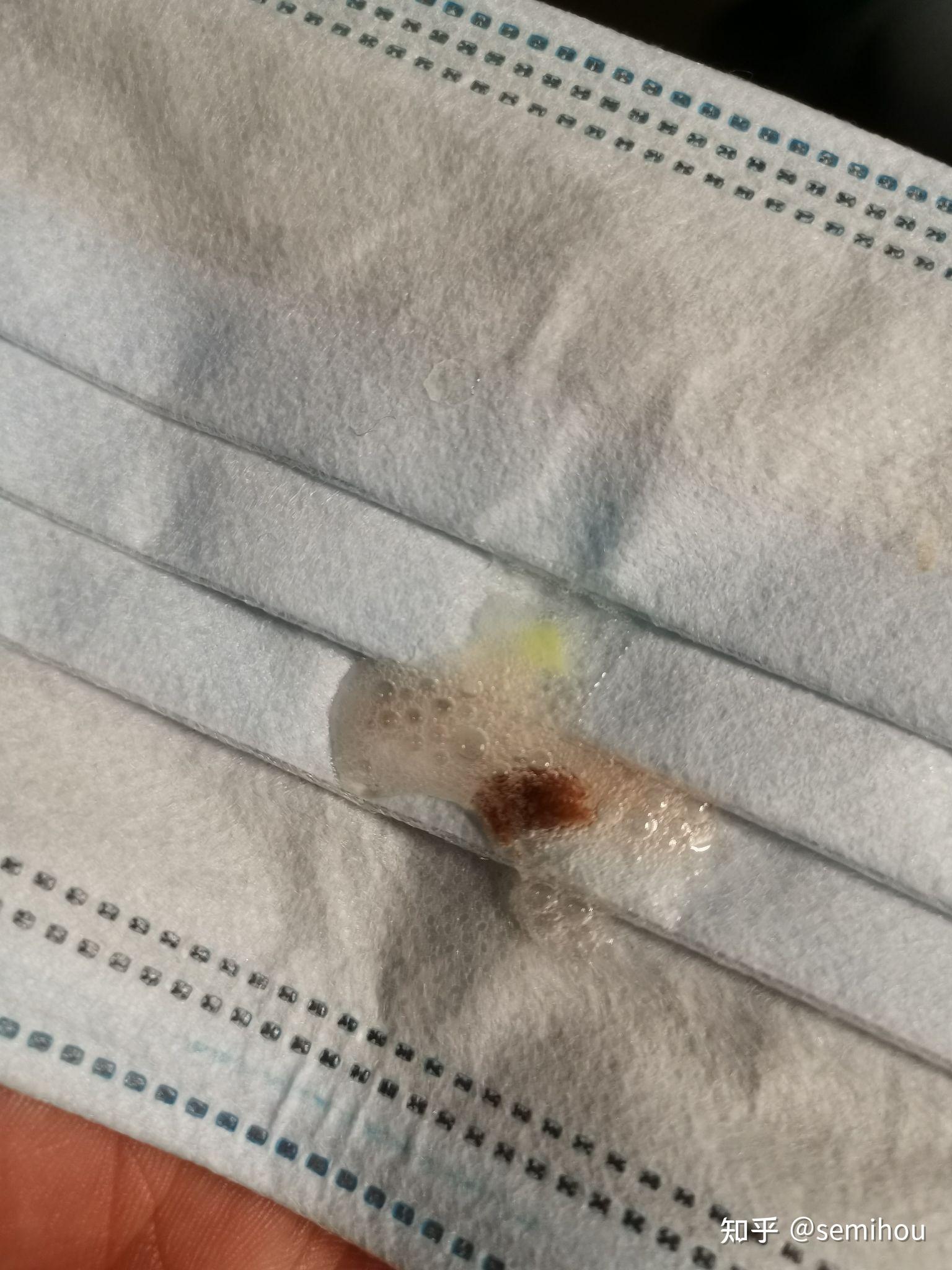 每天早上起床后喉咙经常性出血,一定是慢性咽喉炎么?