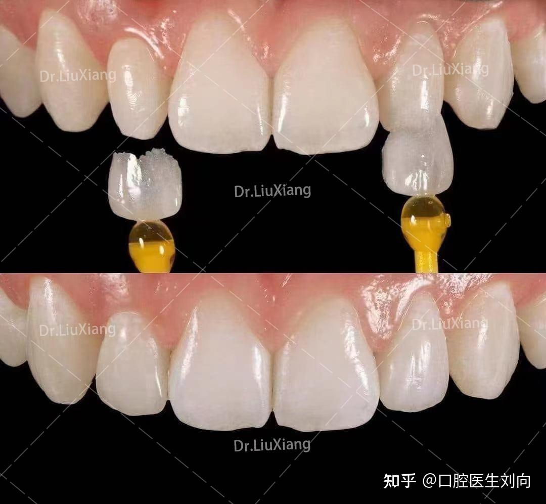 超薄瓷贴面后悔了图片