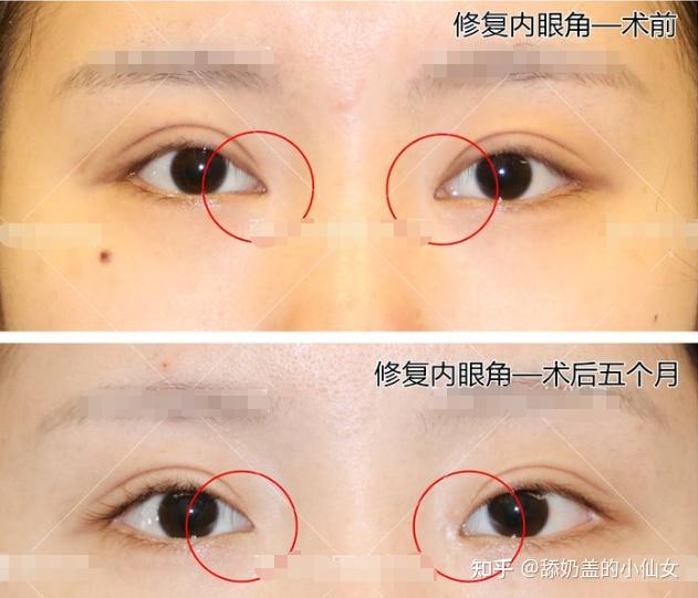 开眼角开大了会不会自然回缩