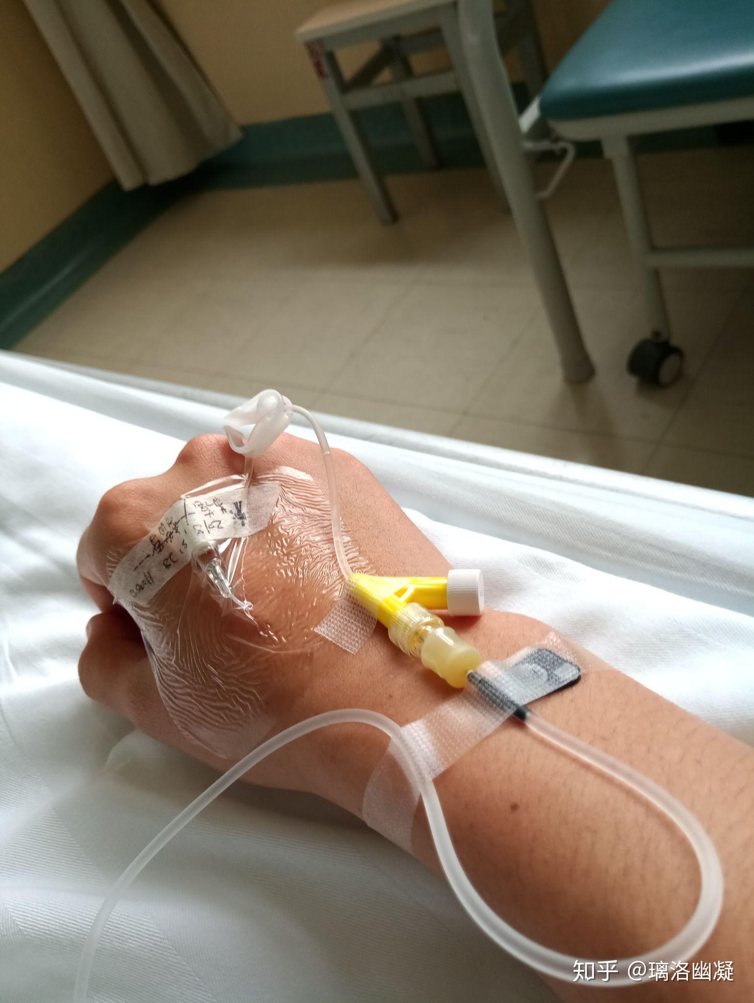 做微创阑尾炎手术是一种什么体验? - 知乎