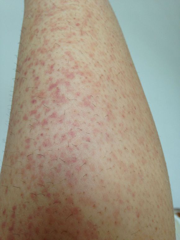 过敏性紫癜案列