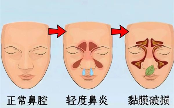 登录/注册 过敏性鼻炎 慢性咽炎 慢性咽喉炎 慢性鼻炎 萎缩性鼻炎