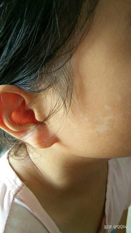 关于汗斑快好的症状是什么,还有就是汗斑一定有皮屑吗?