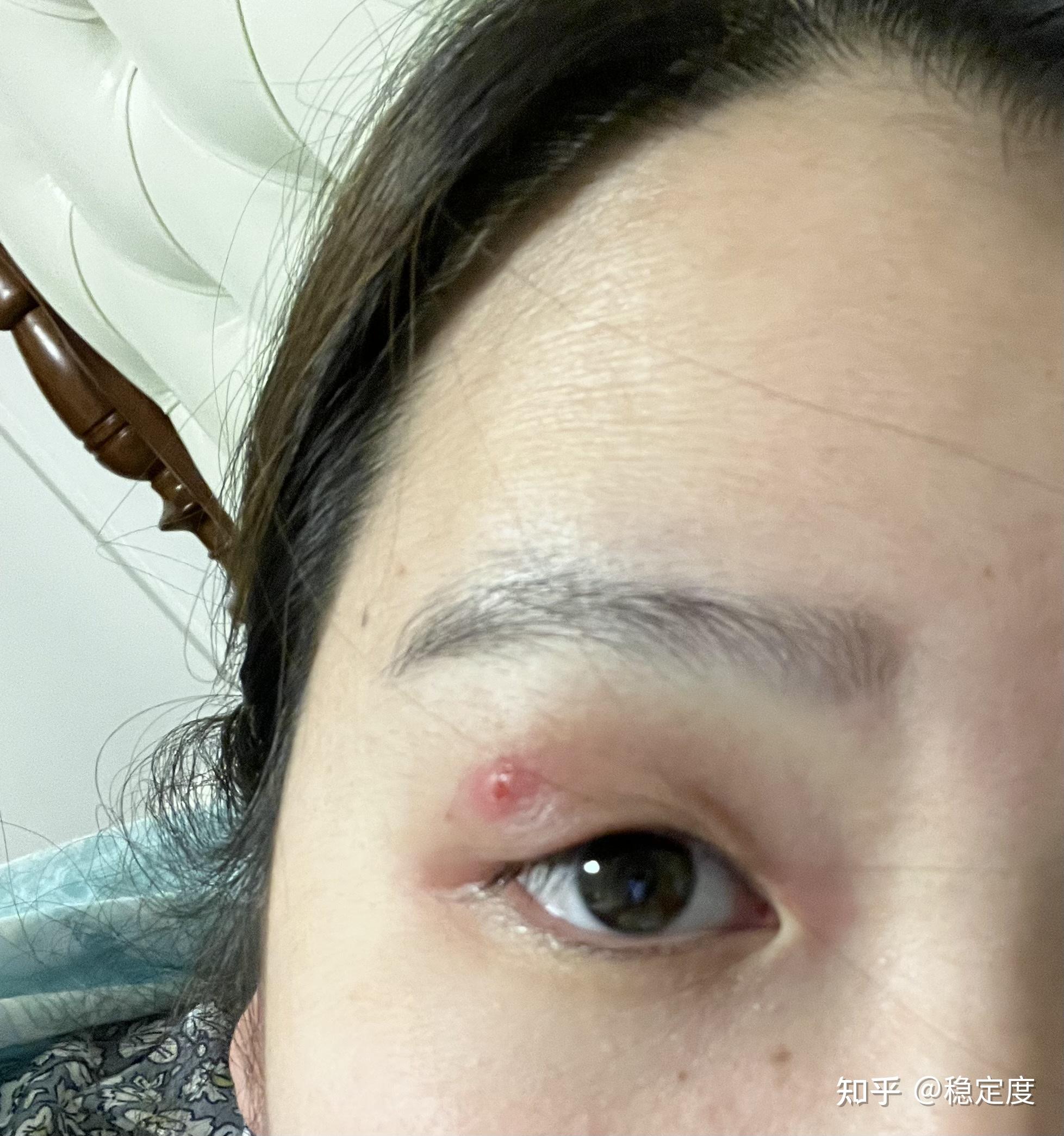 眼皮上起了一个粉刺是什么感受