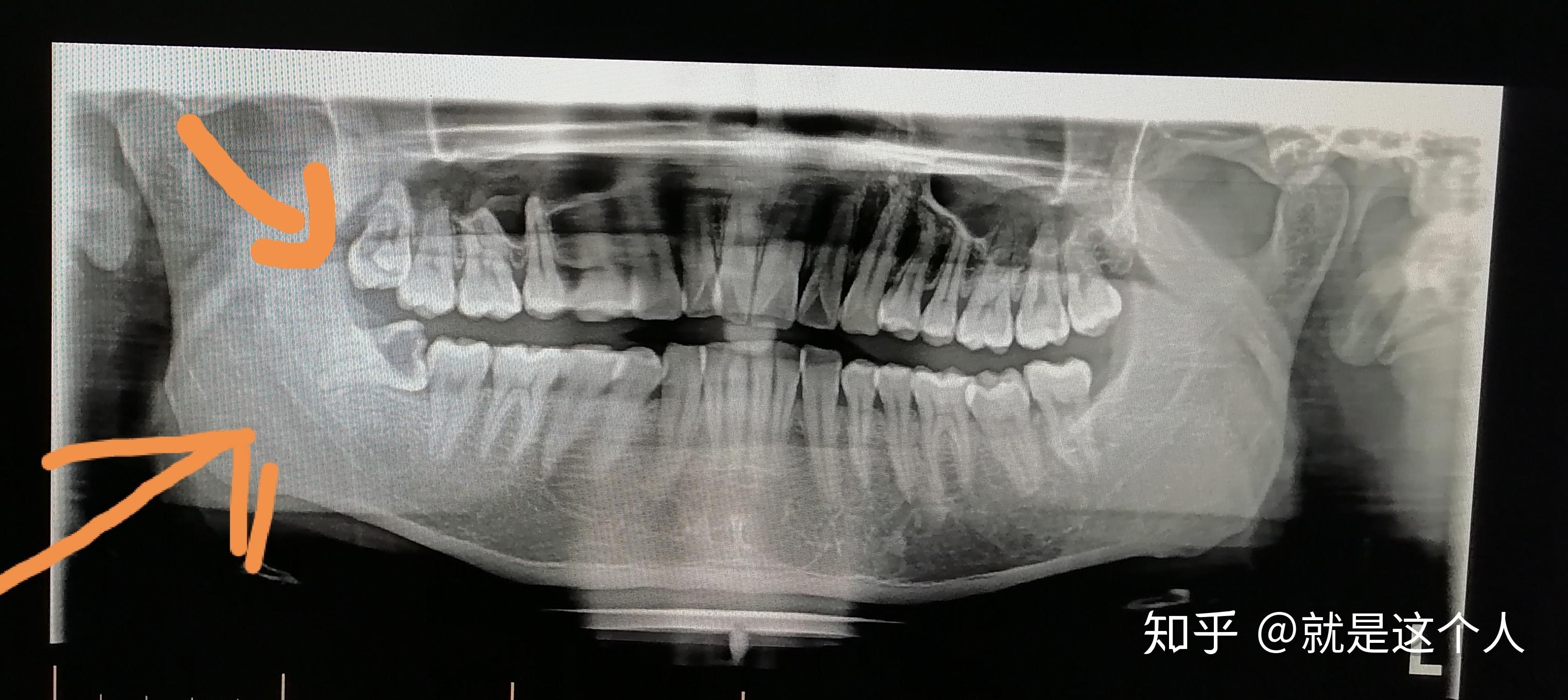 拔了一颗左下颚的阻生齿三甲医院口腔科门诊费用明细如下我请问费用