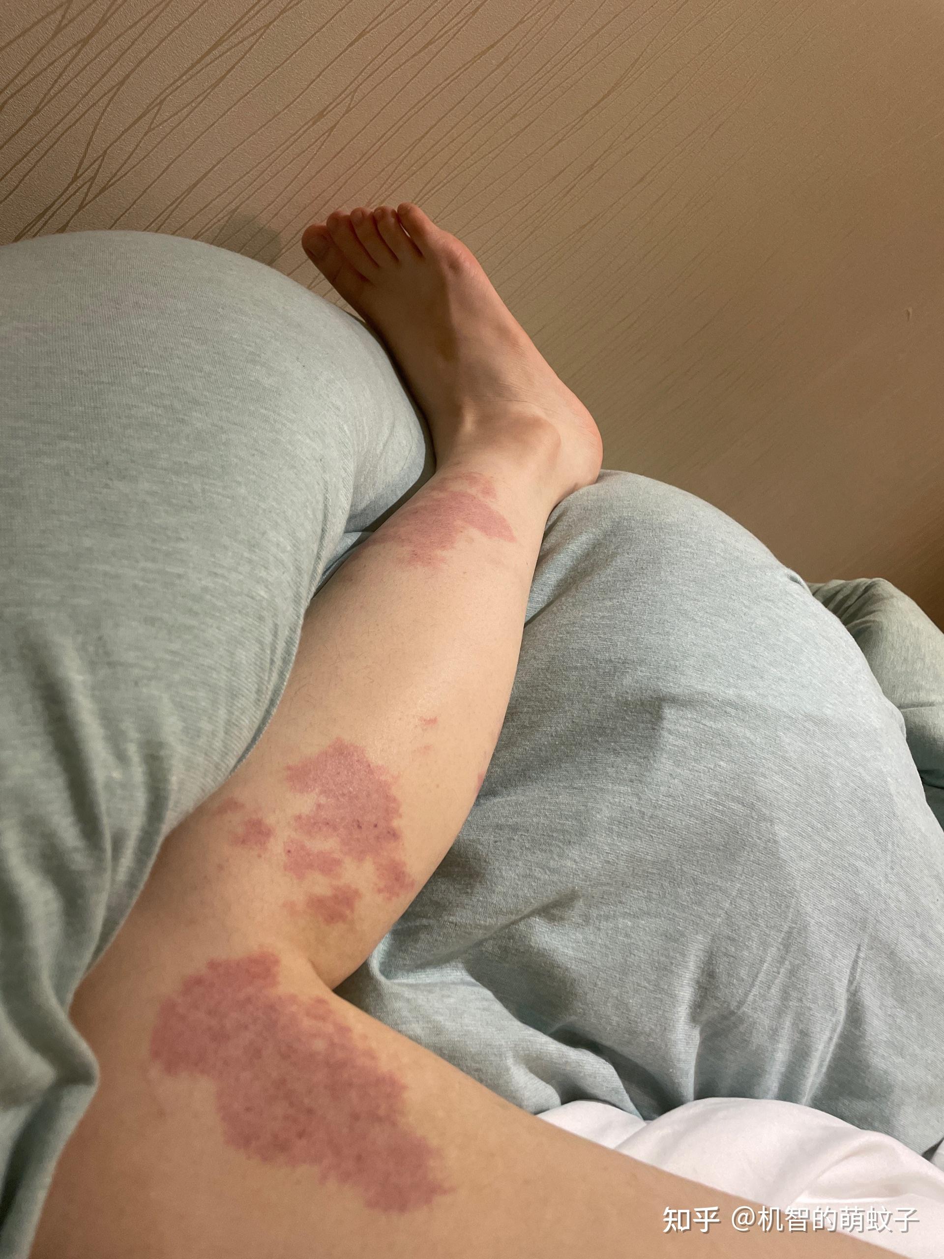 在大街上看到腿上有大面积胎记的女生露腿会反感吗