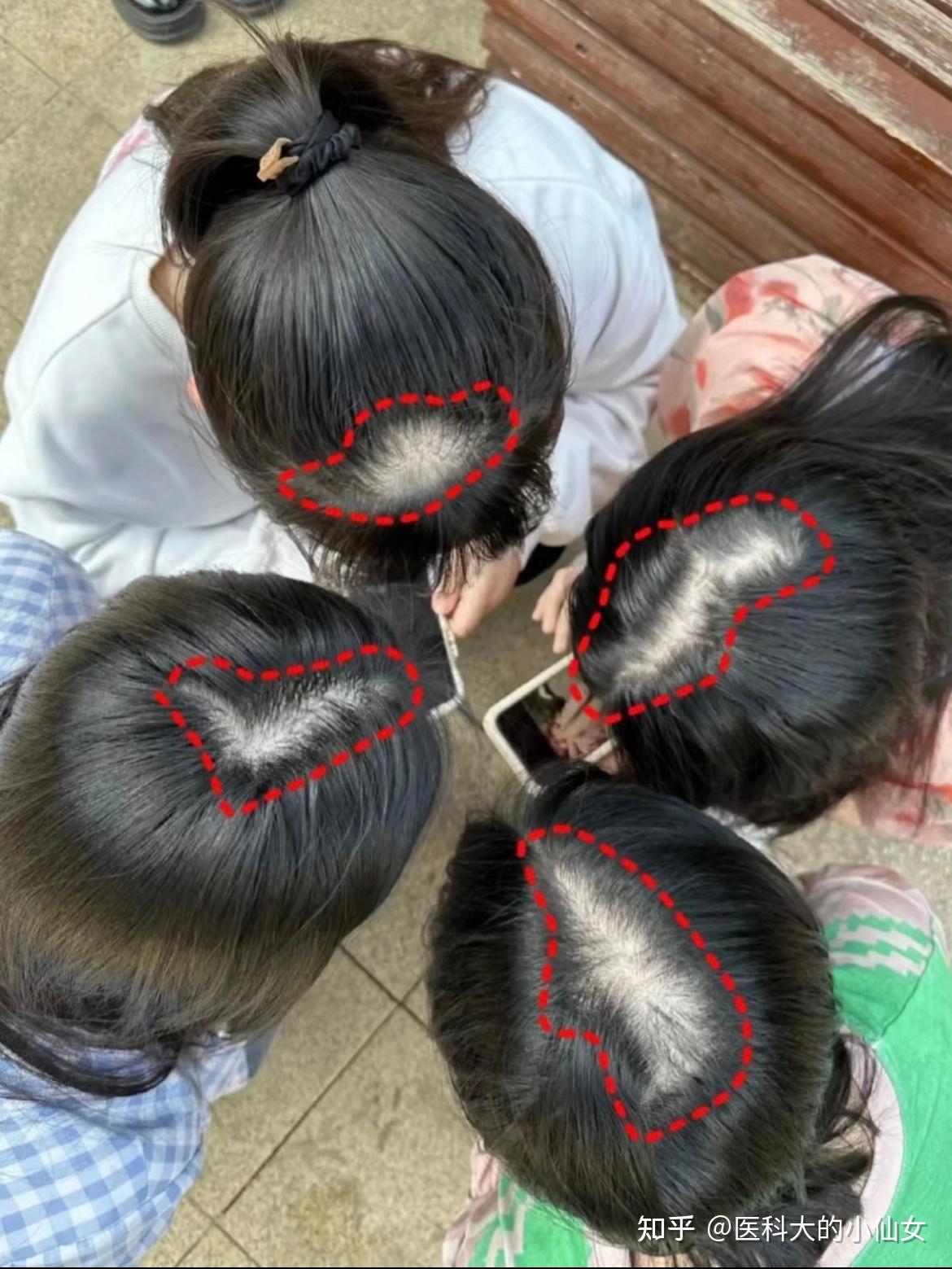 15岁女生脱发严重怎么办? - 知乎