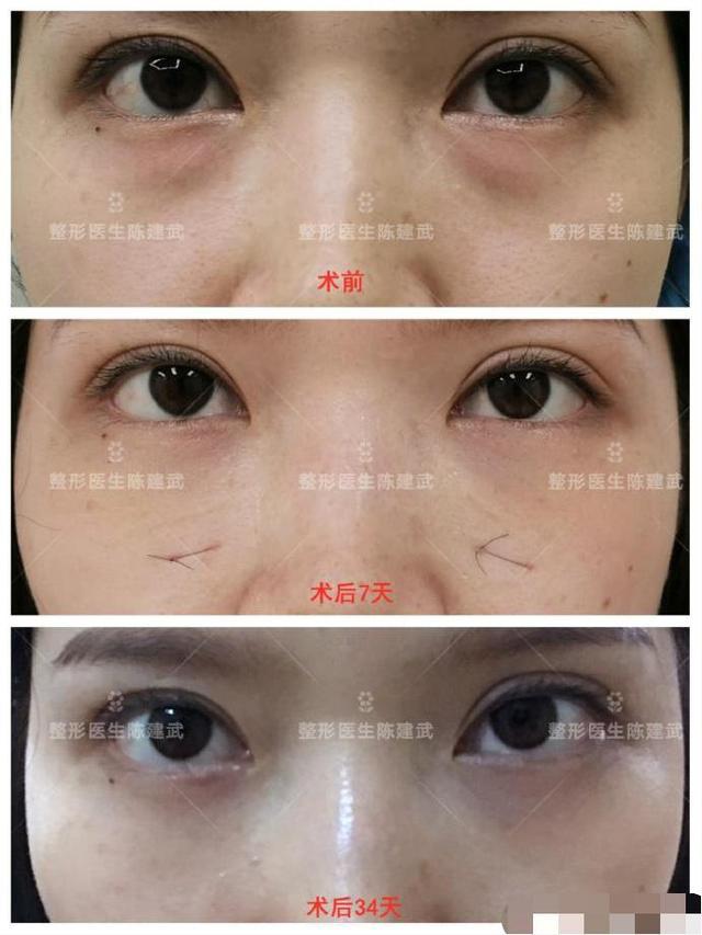 内切眼袋眶隔脂肪释放手术第七天完全恢复