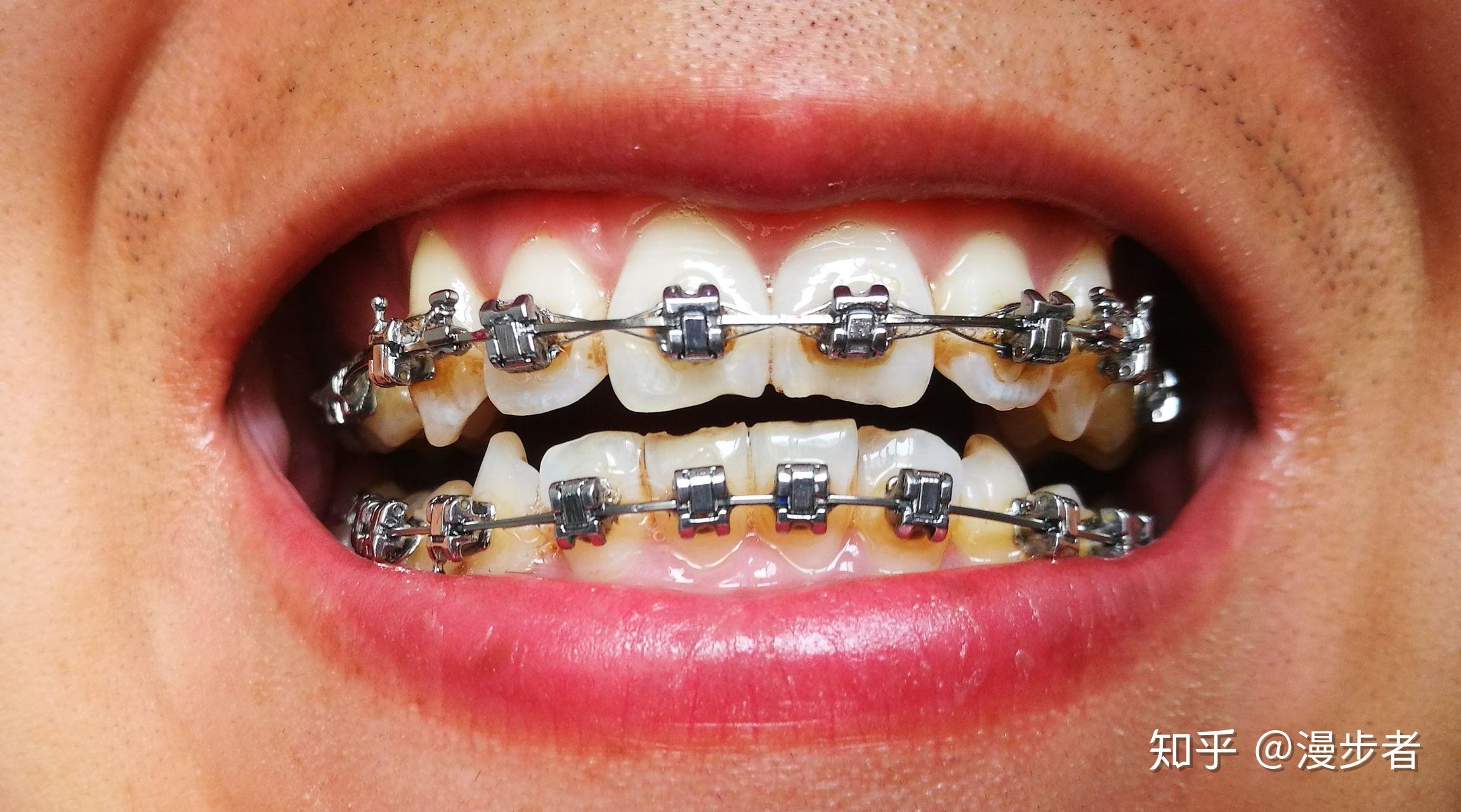 正畸用的进口的自锁托槽和国产的自锁托槽有什么区别?