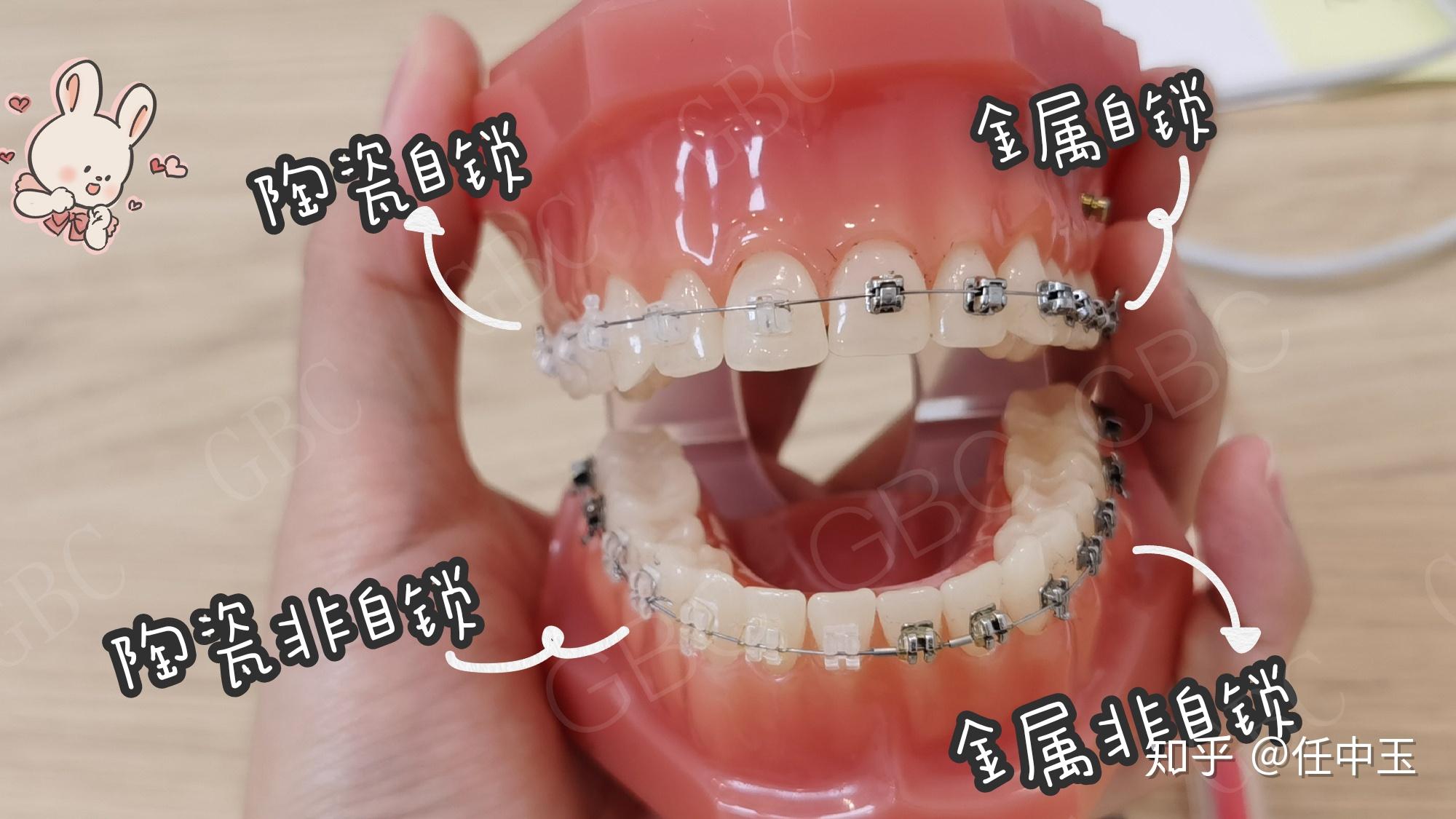 金屬自鎖和陶瓷非自鎖推薦哪個