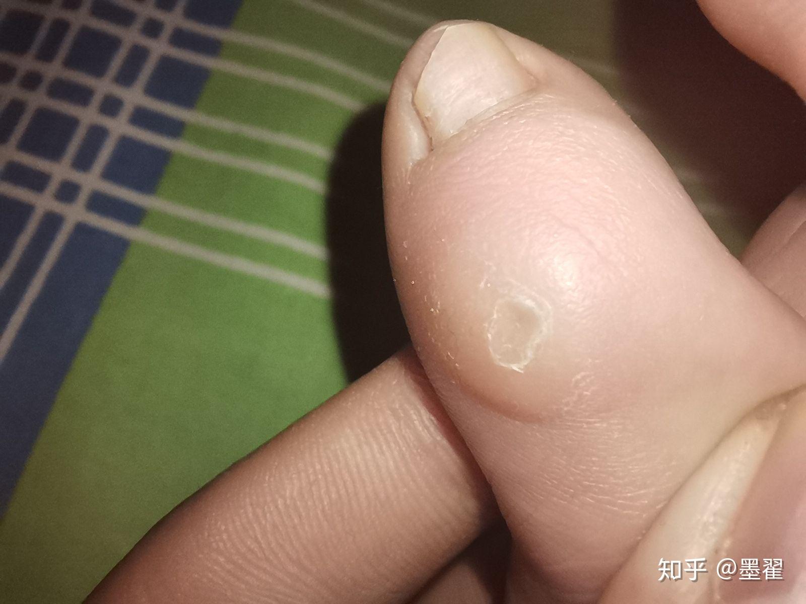 请问我小脚趾磨出的那个茧是鞋的问题还是我的脚问题