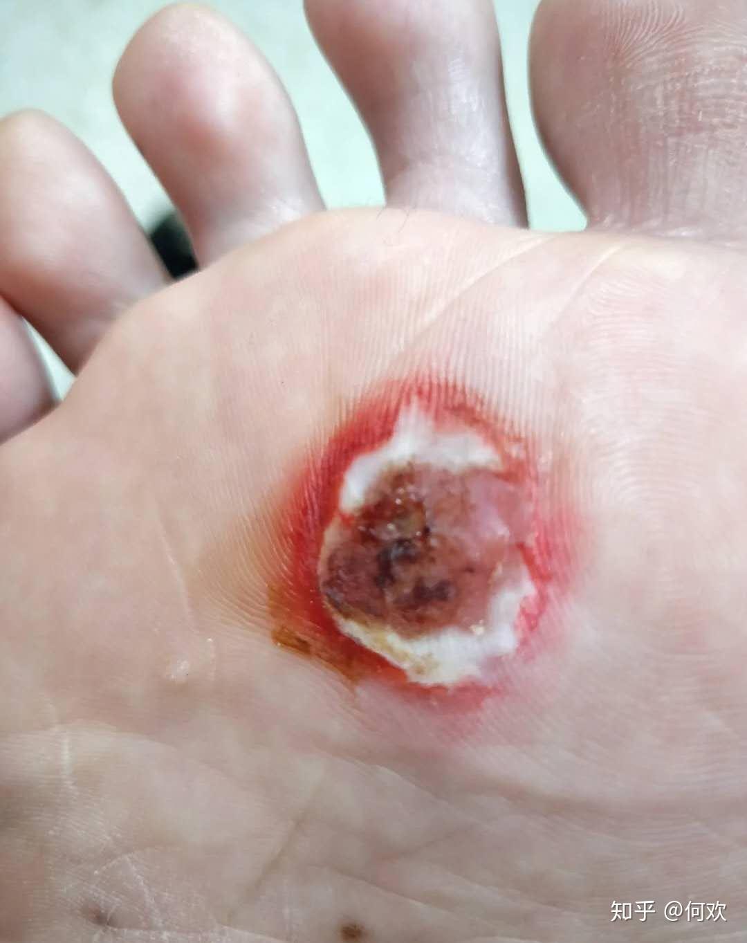 脚上长了鸡眼用什么方法可以治好呢