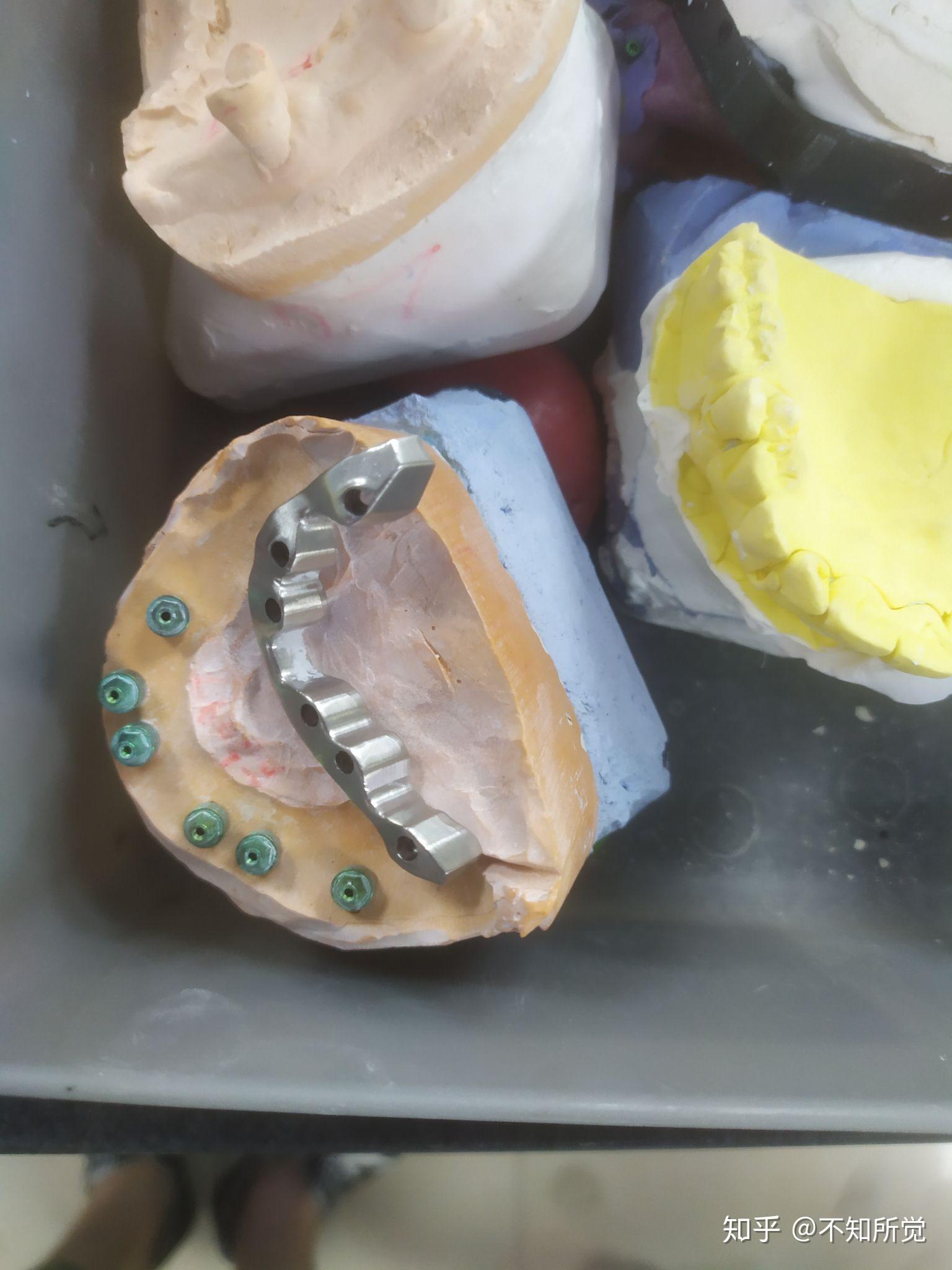覆蓋式活動假牙Overdenture - 全口重建贋復假牙科 林正忠醫師
