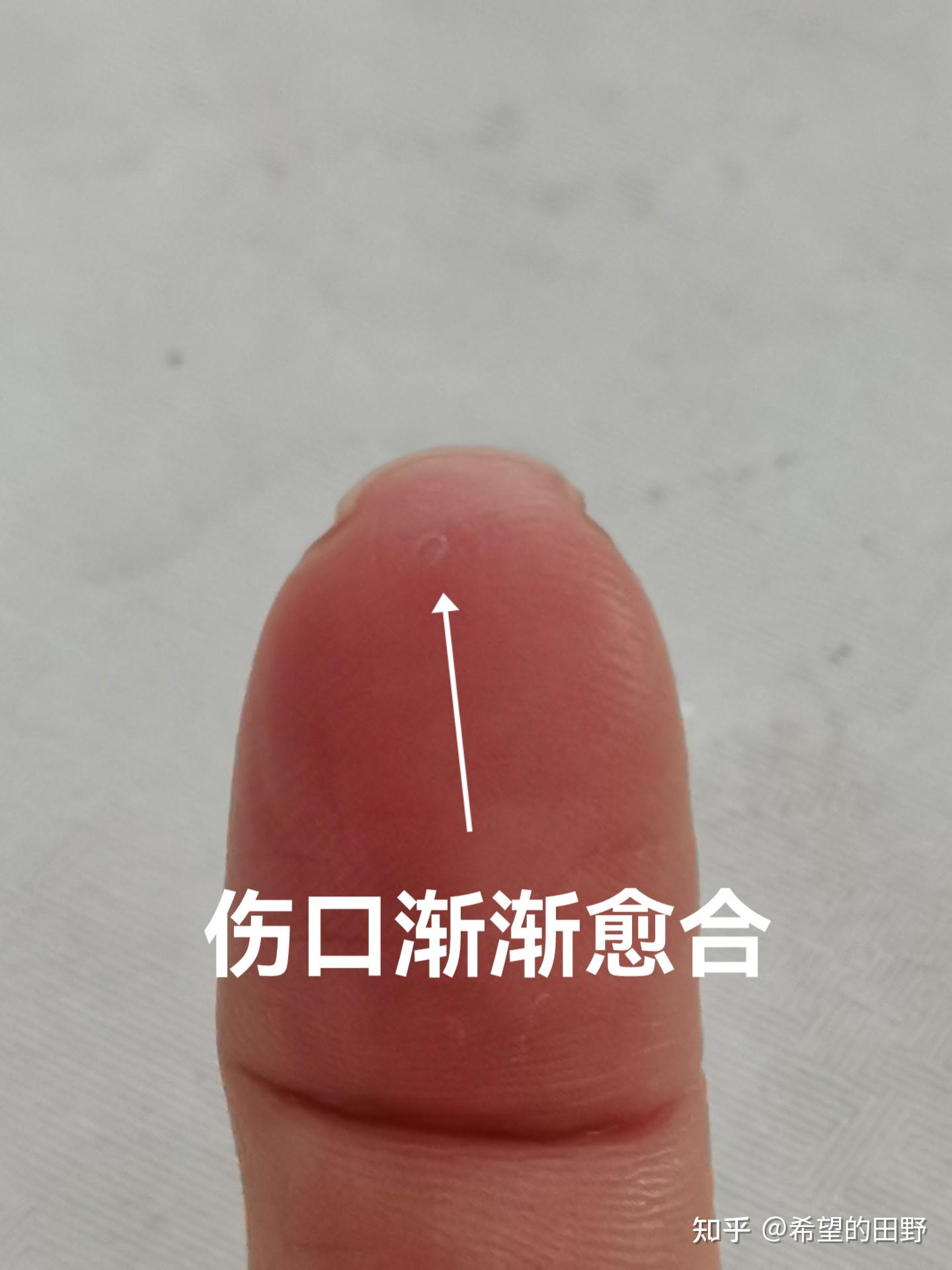 拔手中刺 - 知乎