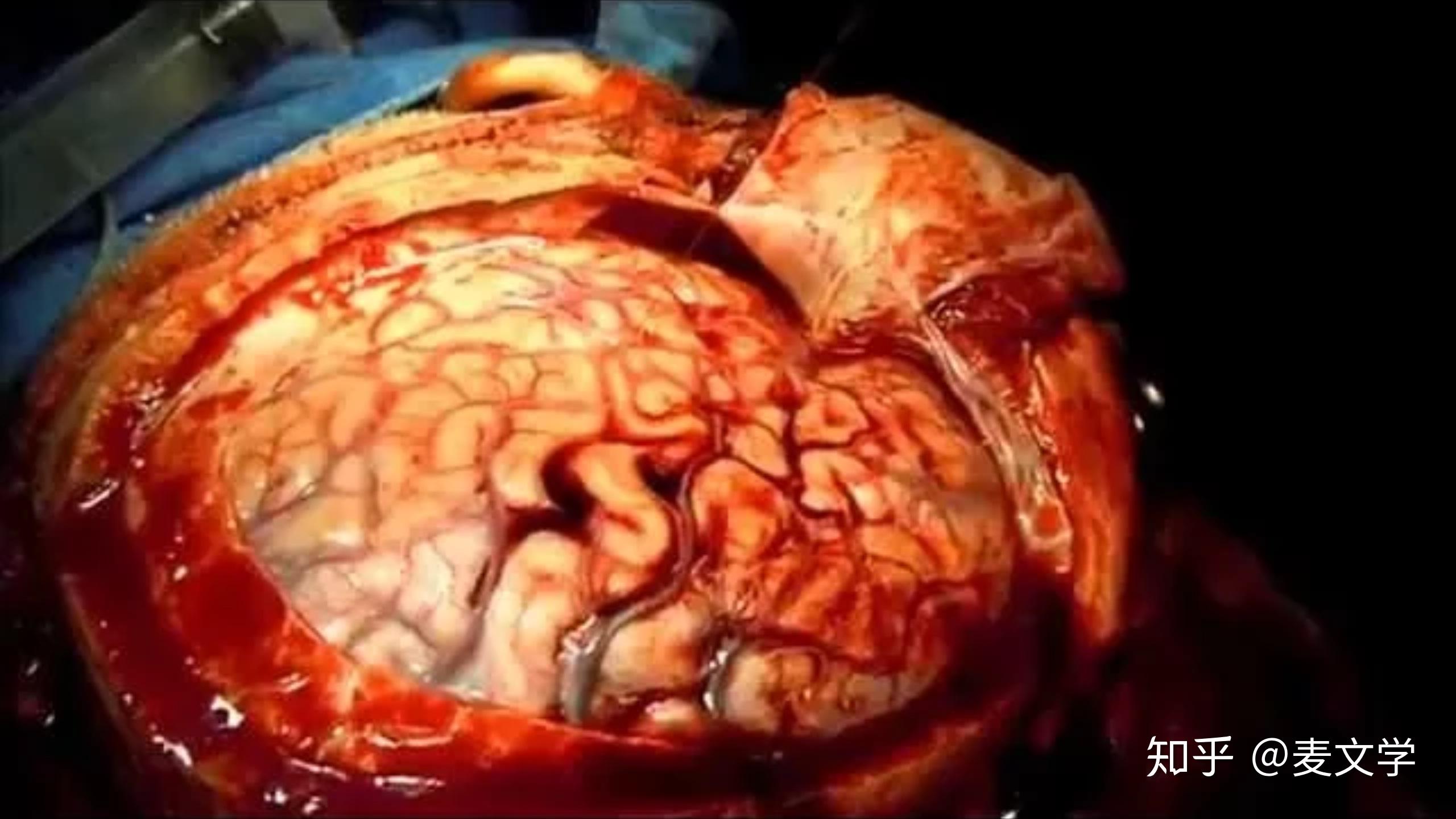 人的脑袋剧烈晃动的时候脑子为什么不会变成一团浆糊? - 知乎