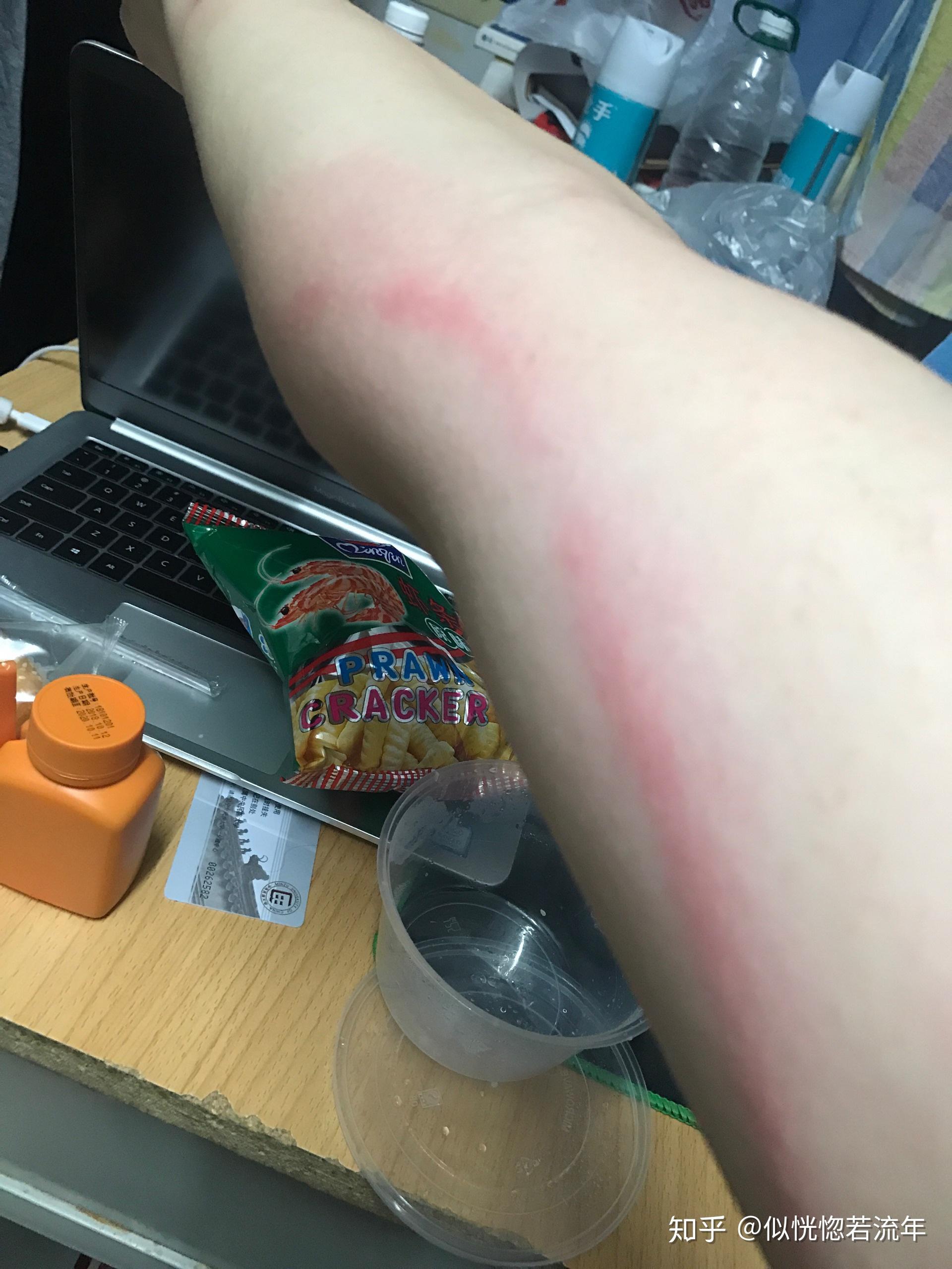 被虫子咬了胳膊上一条红线往上延伸这是什么