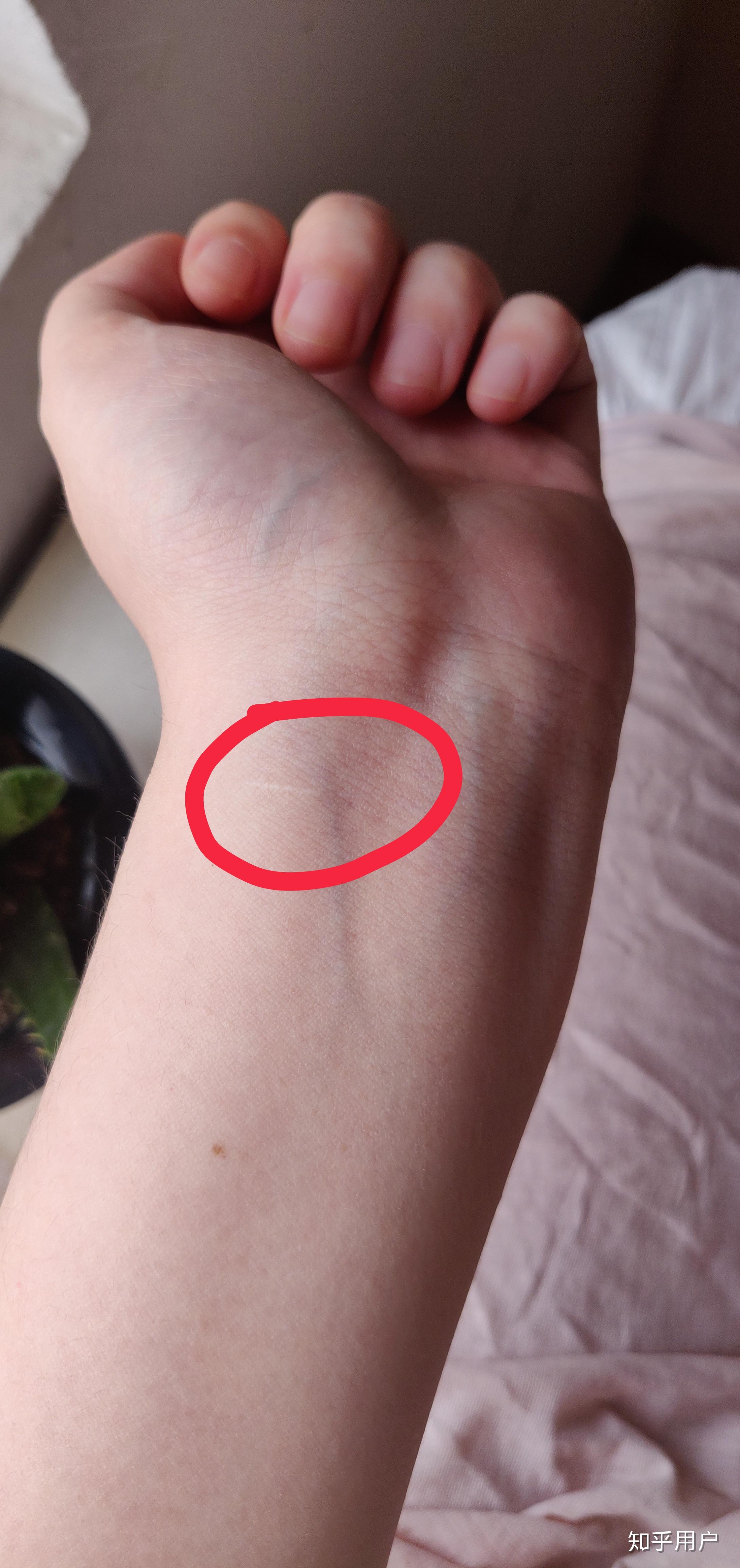 割腕的疤可以去掉吗