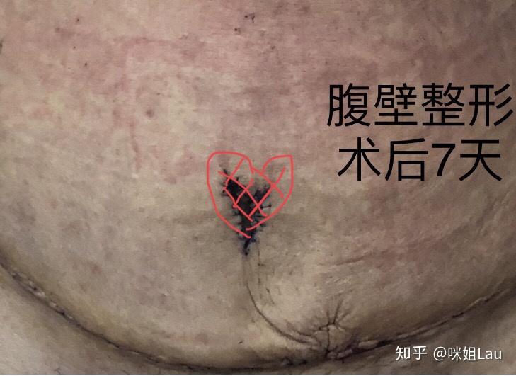 三年前做的剖腹产二胎,肚子上的赘肉不堪入目.是不是必须做腹壁整形?
