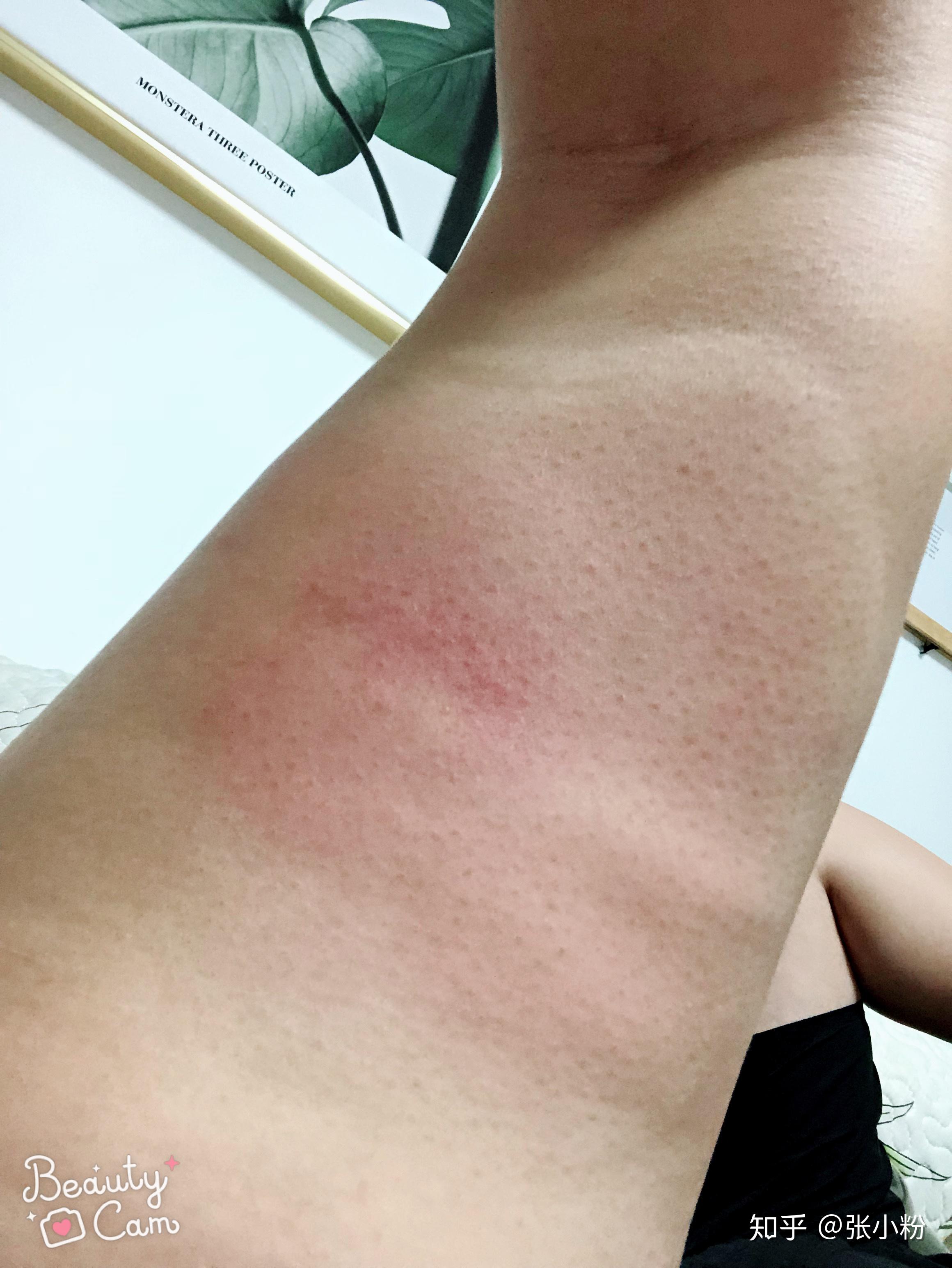 被蚊子咬的包第二天都肿的特别大怎办? - 知乎