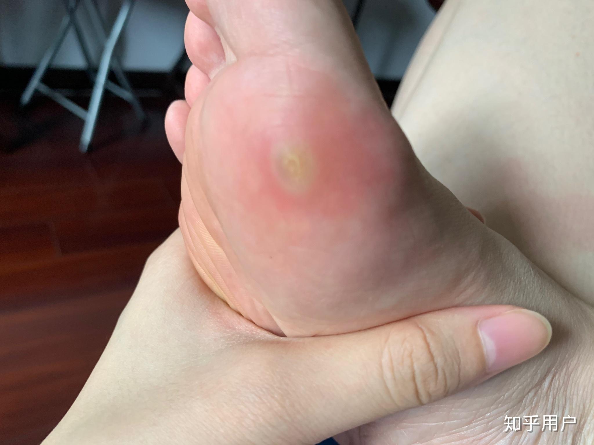 我脚上长了跖疣请问该怎么治疗