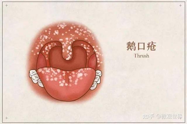 婴儿容易中招的口腔真菌疾病——小儿鹅口疮 - 知乎