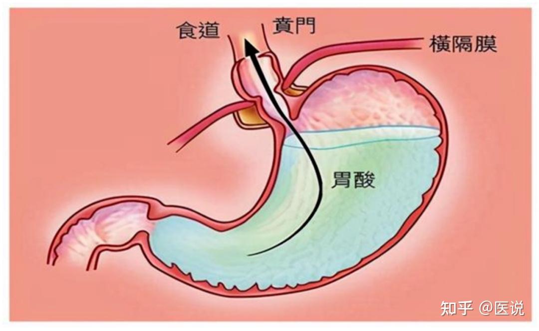 儿童幽门梗阻图片