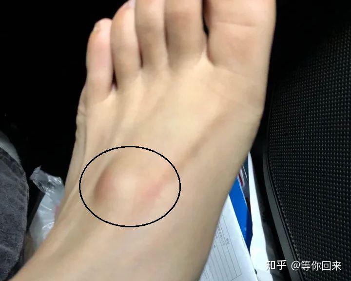 左脚脚背左侧长了个腱鞘囊肿,微胀痛,该如何治疗? - 知乎