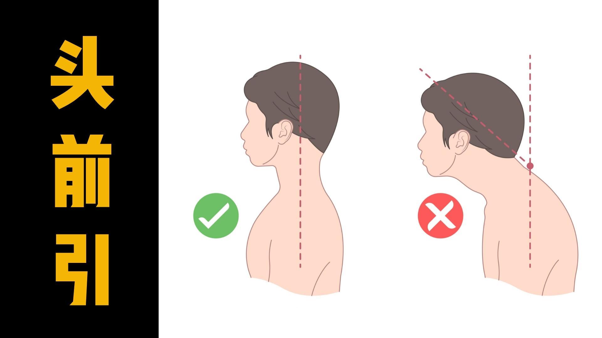 体态矫正:如何改善头前引? - 知乎