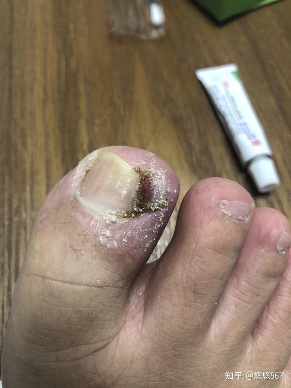 甲沟炎息肉如何清除