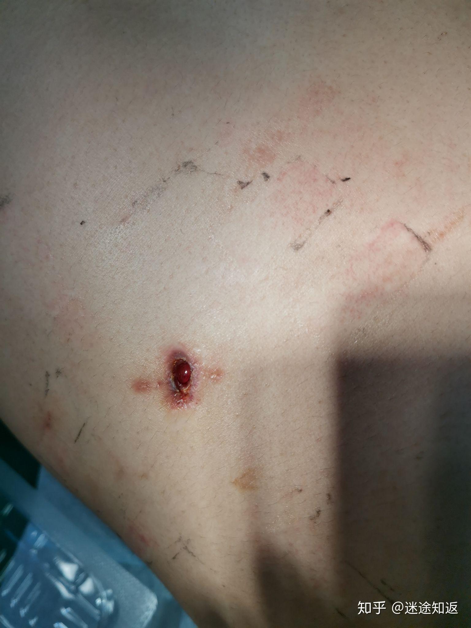 做微创阑尾炎手术是一种什么体验