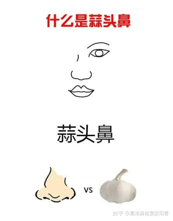 蒜头鼻怎么改善? - 知乎