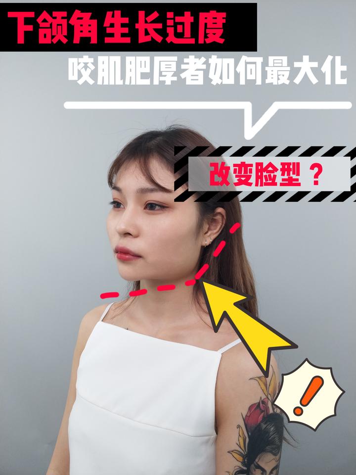 国字脸宽脸方脸怎么改善脸型改善面部轮廓有哪些手术下颌角长曲线截骨