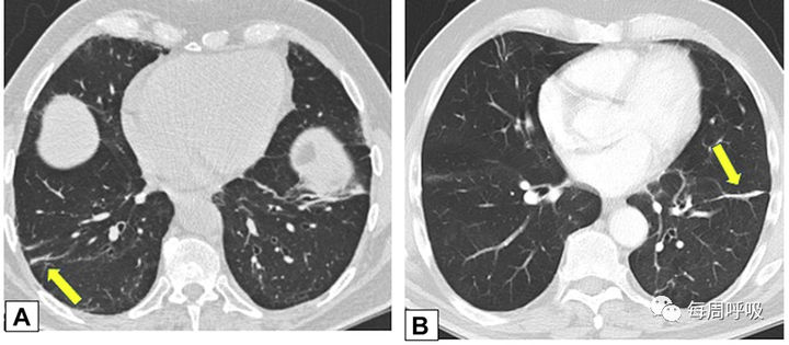 图片[15]-CHEST综述：机化性肺炎的诊断流程（临床-影像-病理特征相关性） | 每周呼吸-每周呼吸