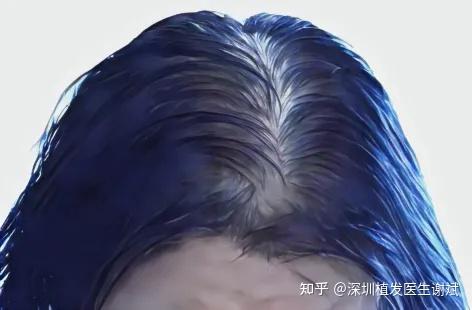 女性脱发的七大原因你属于哪种?美女必看! - 知乎