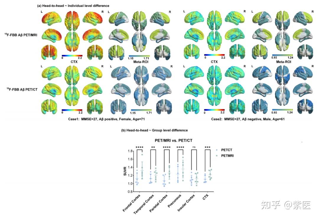 多强合作，AD脑成像大突破！PET/CT与PET/MRI迎来“统一标准” - 知乎