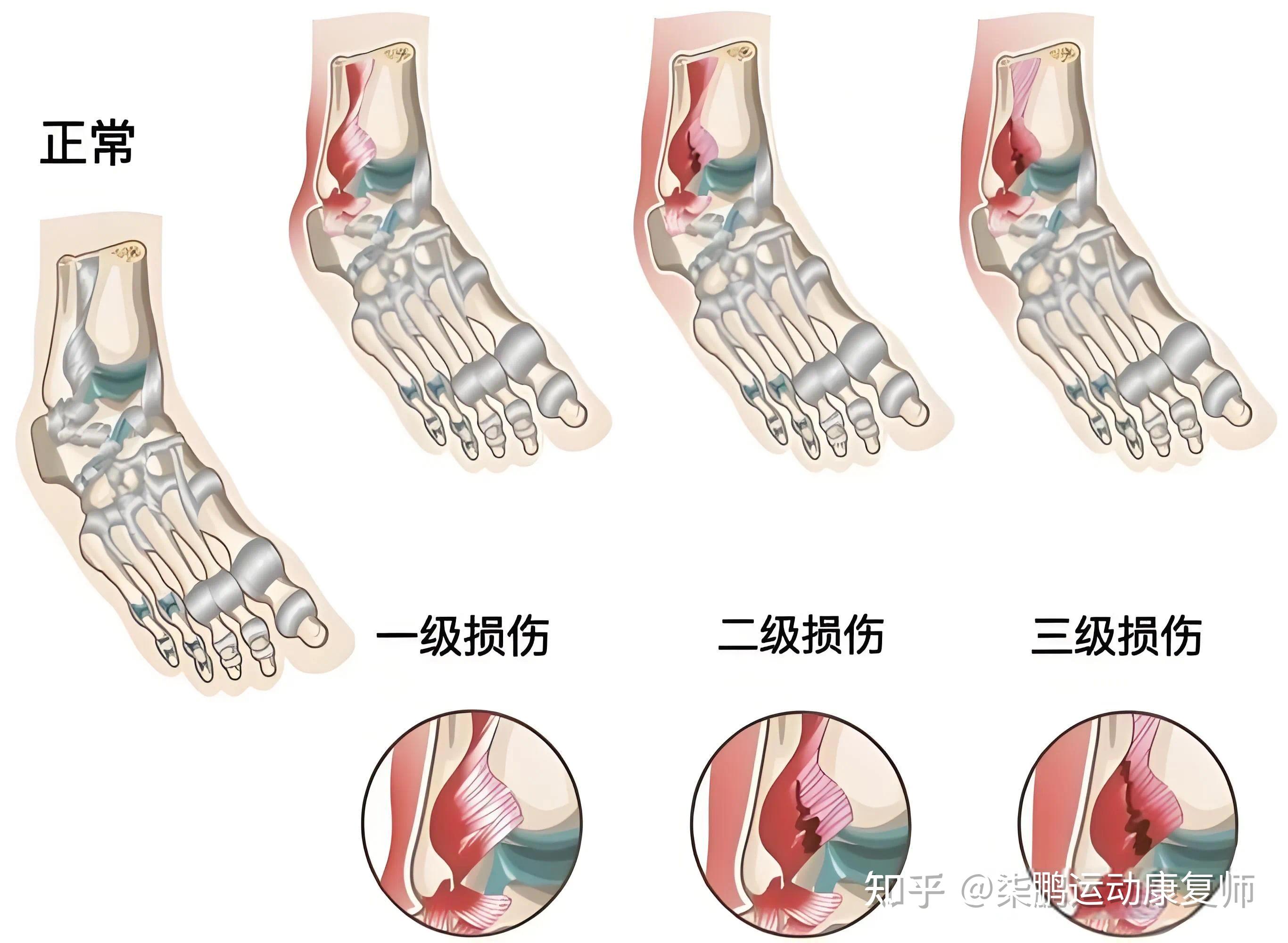 脚踝扭伤需要多长时间才能治愈? - 知乎