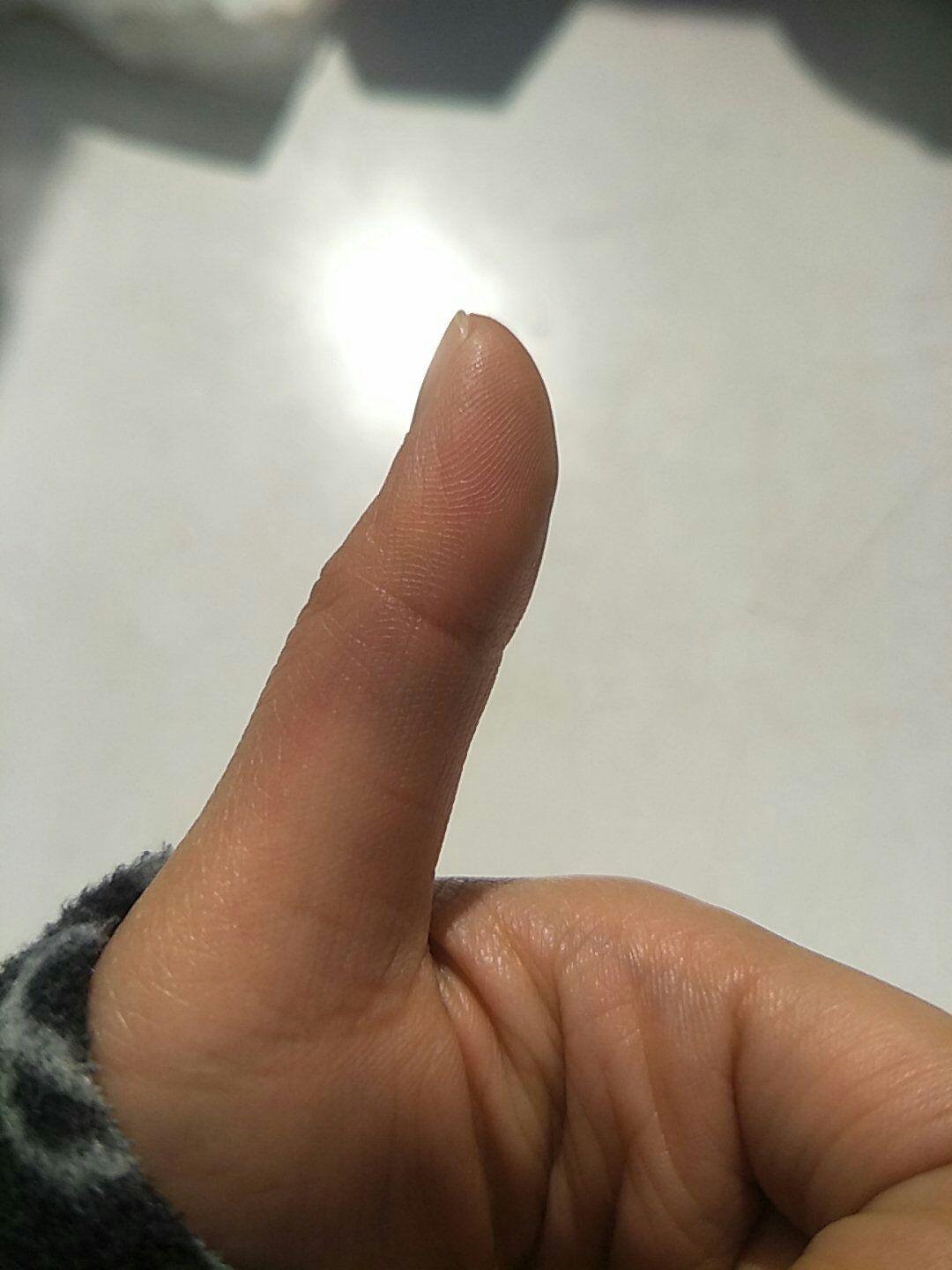 左手大拇指下大鱼际侧有隐痛按压后出现淤青有没有懂中医的求解没有撞