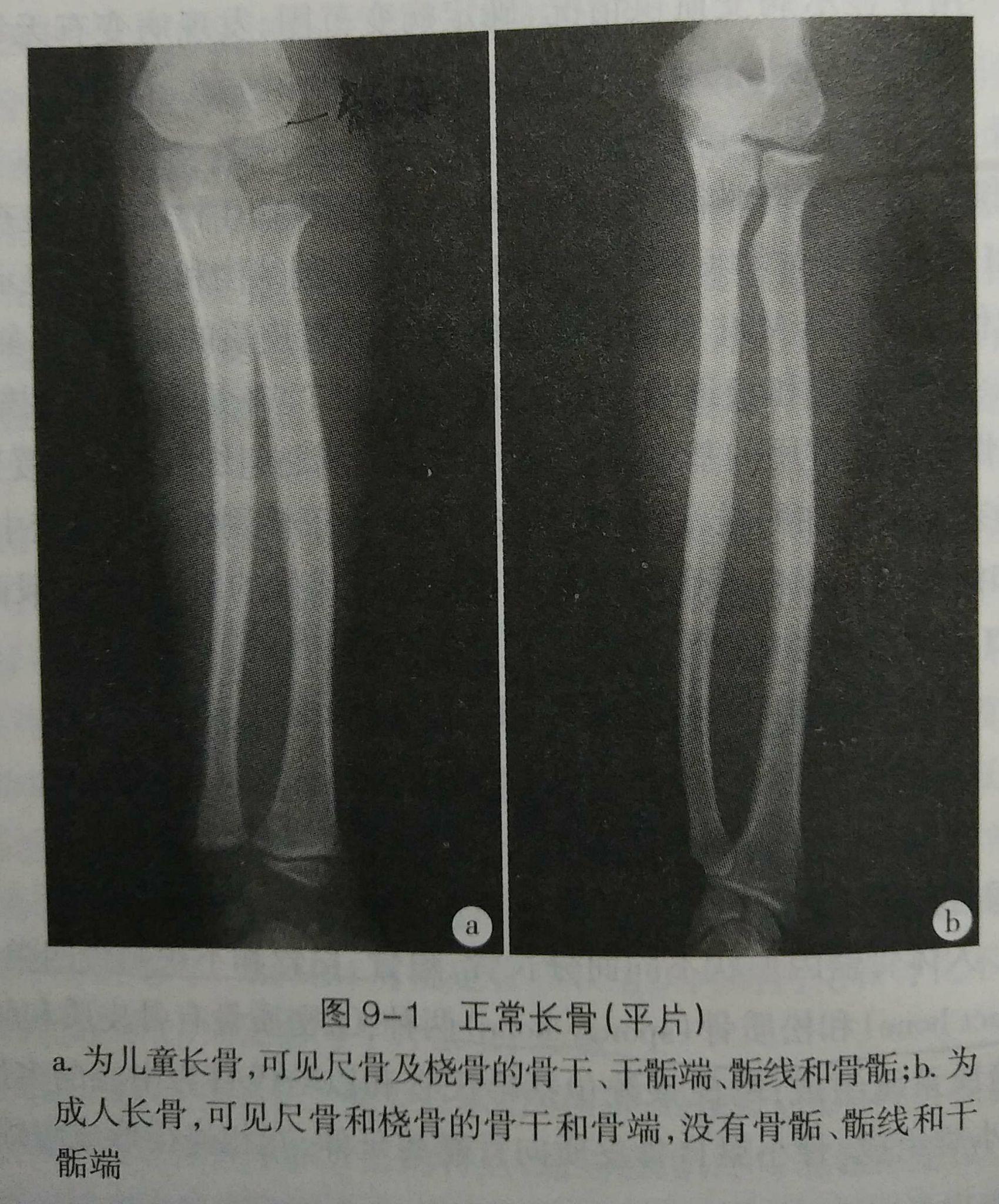 尺骨橈骨 – Dongfeng