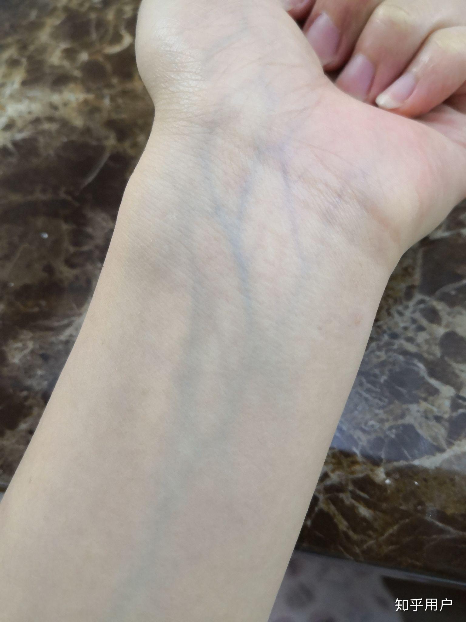 为什么皮肤上看到明显青绿色血管