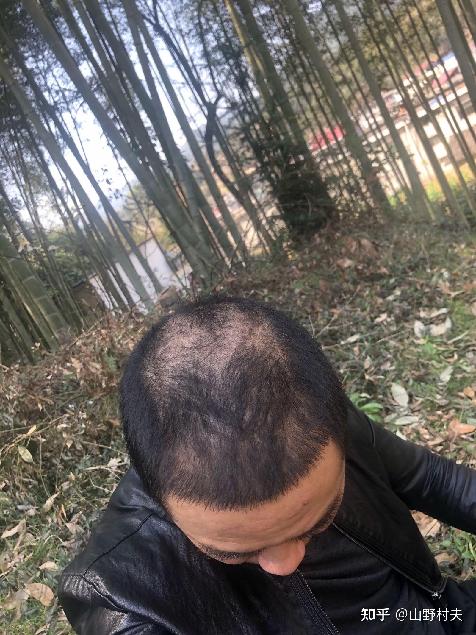 我今年17雄性激素脱发我应该怎么面对活下去