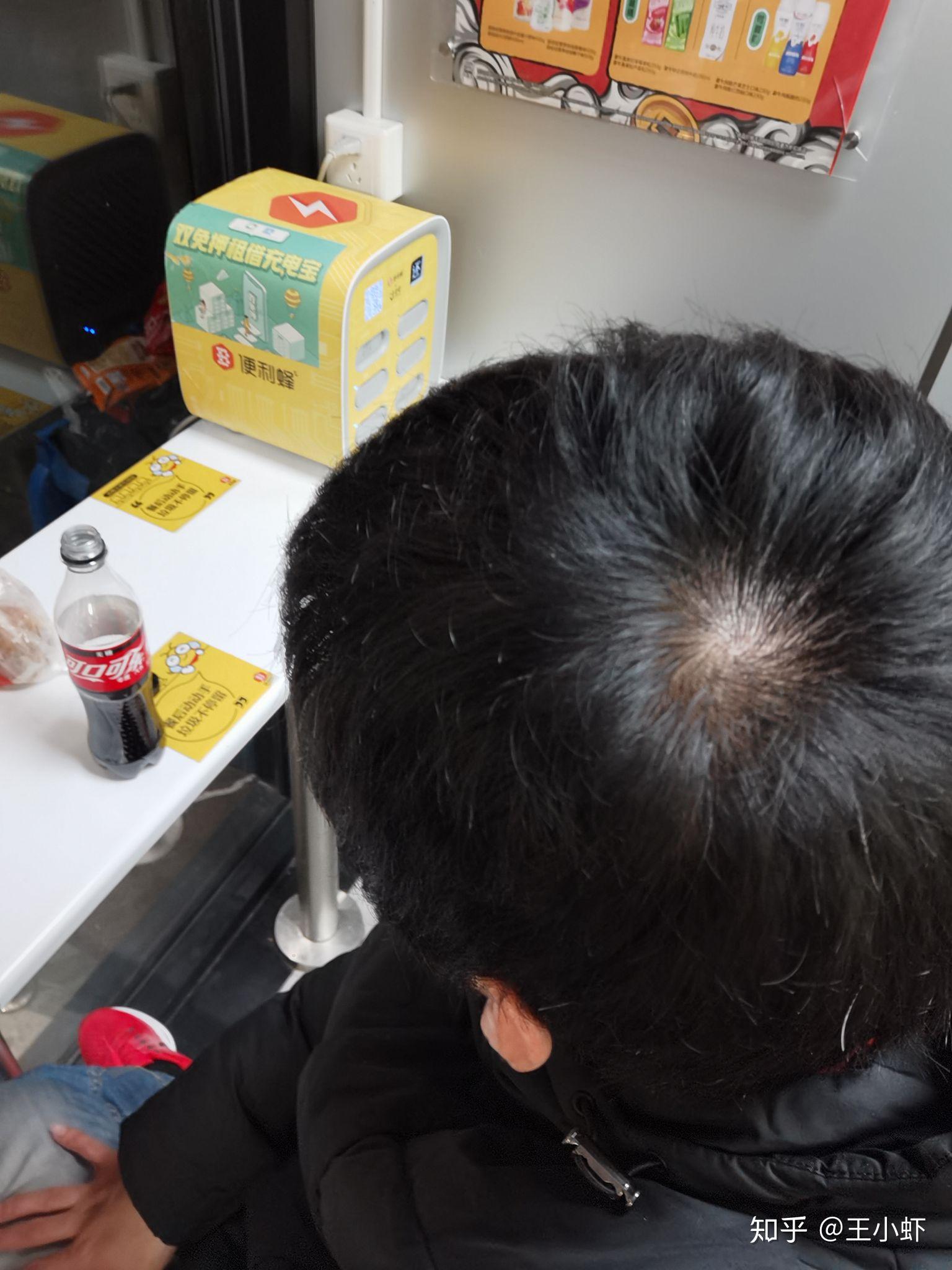 什么样子的发旋是正常的啊? - 知乎