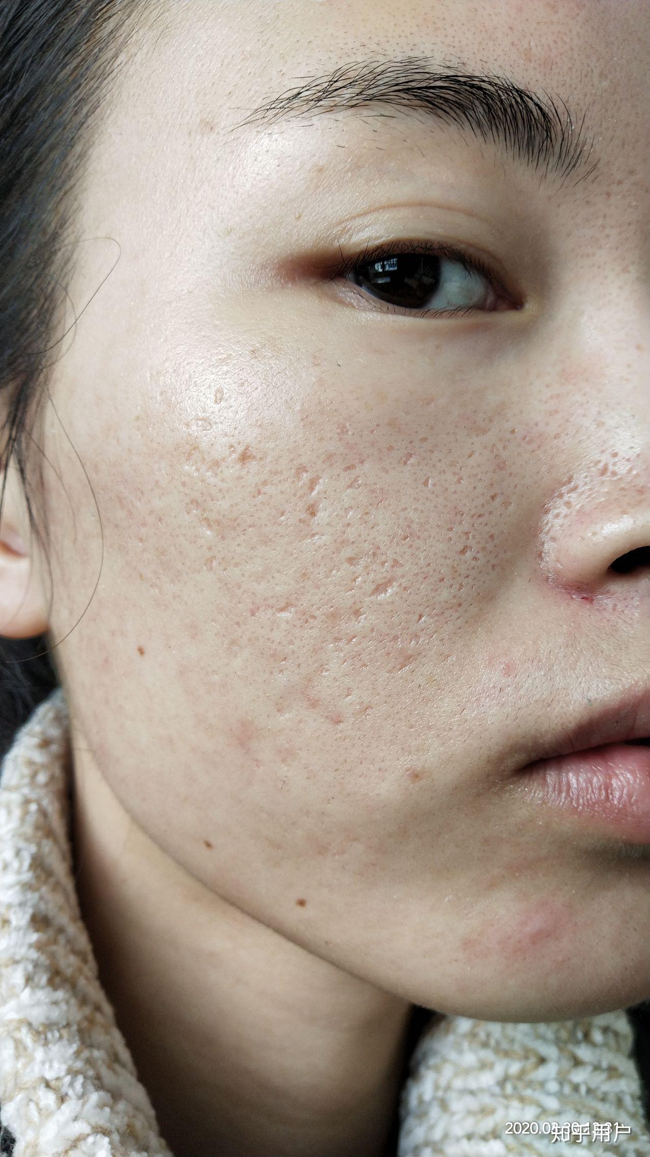 满脸痘坑毁容了的女孩还能奢求爱情吗? - 知乎