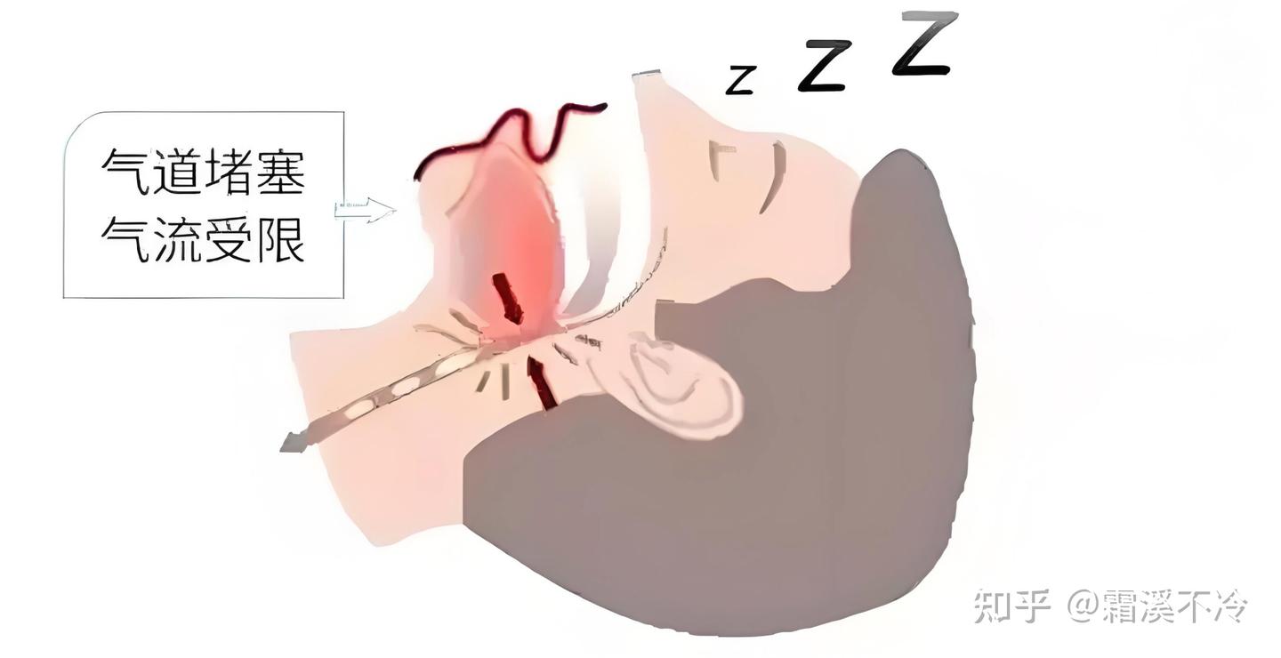 女性晨起头痛、月经不调、睡眠质量不好这些竟然都与睡眠呼吸暂停综合征（OSAS）有关？ - 知乎