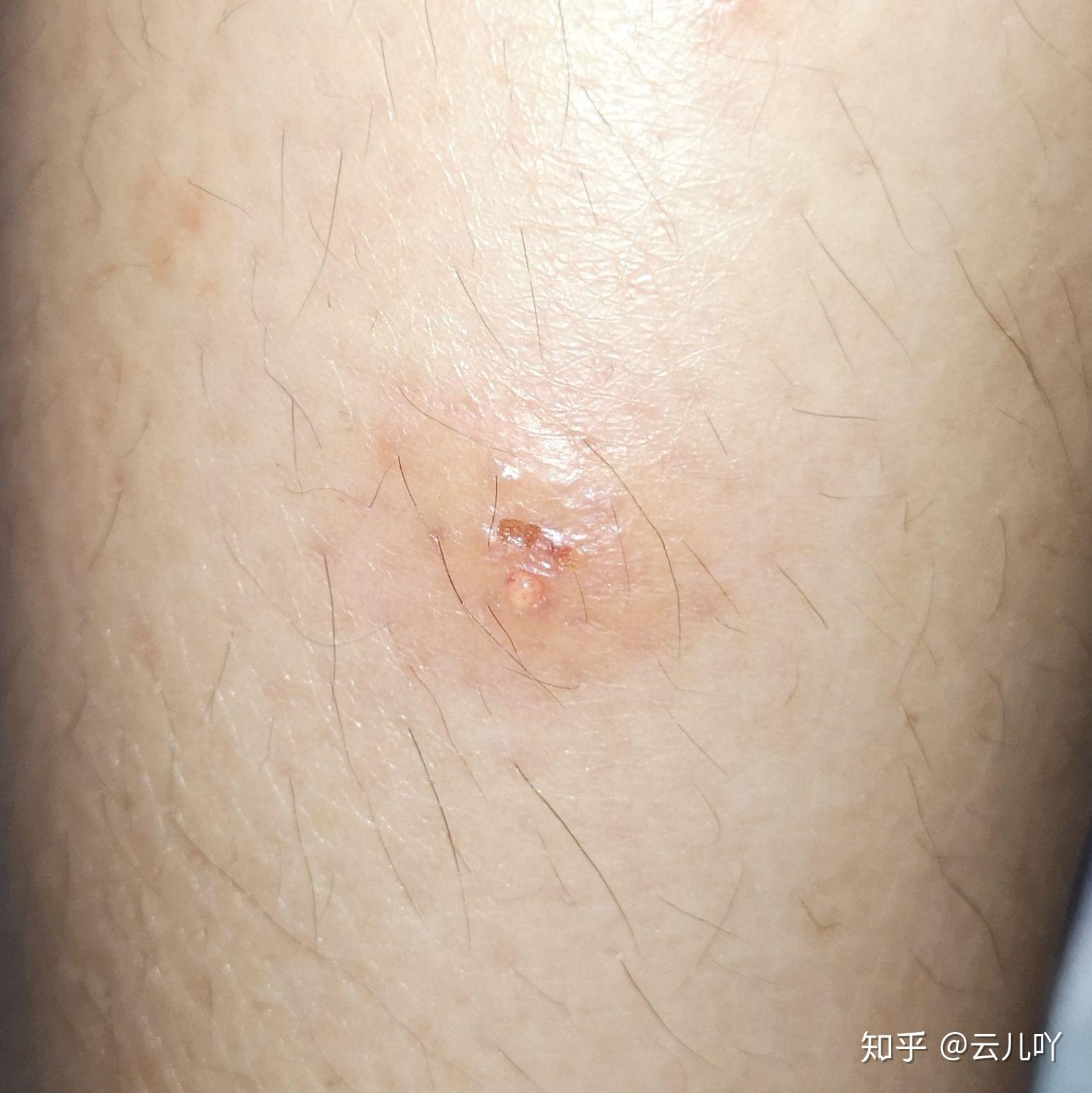 臭虫咬过的疙瘩什么样