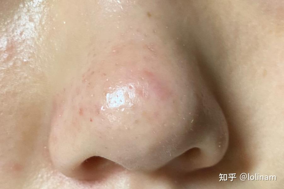 我的鼻子因为挤黑头成这个样子了 怎么恢复啊啊啊啊啊啊啊! - 知乎