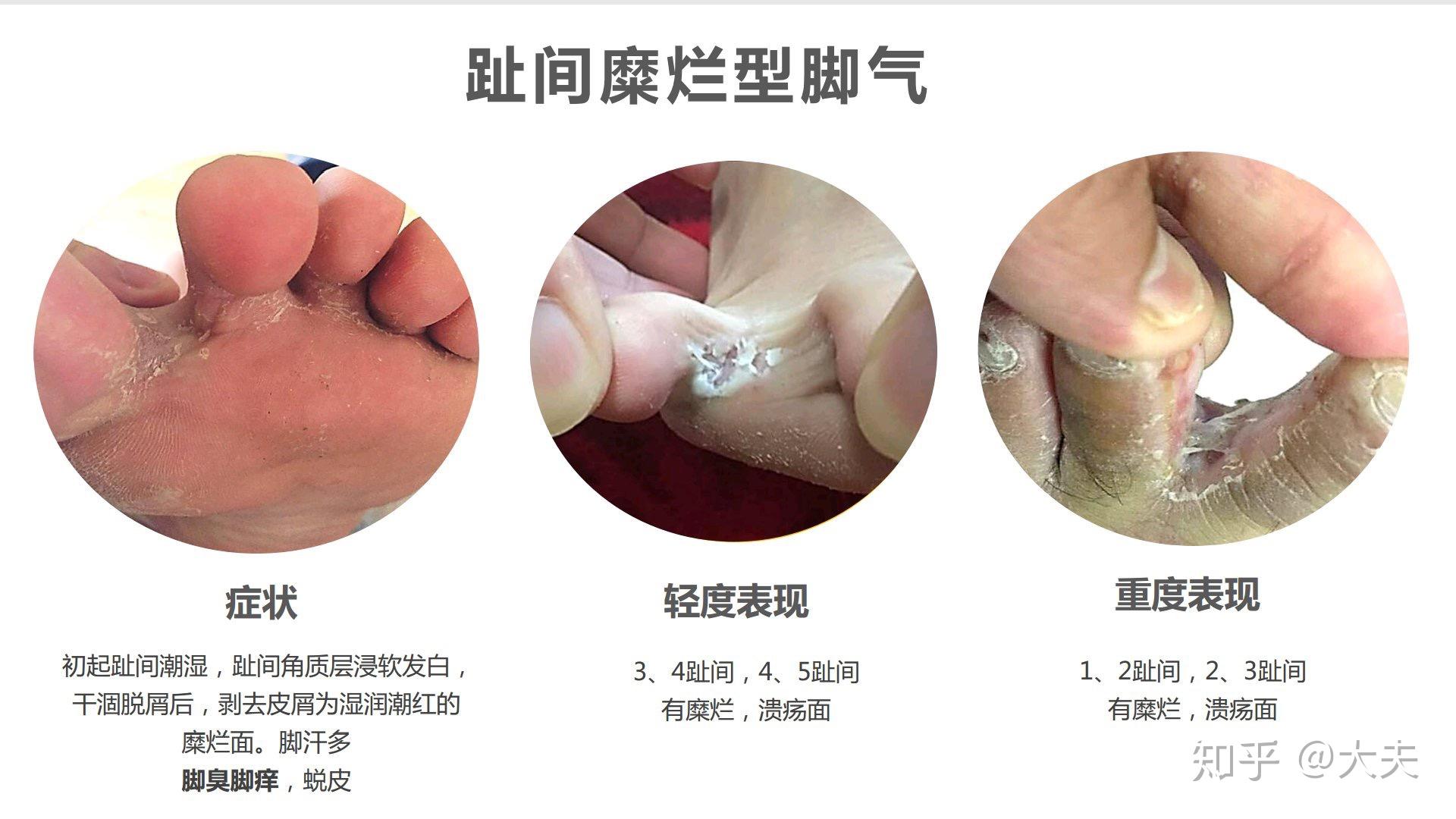 什么是脚气怎么判断自己有没有脚气