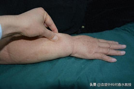 上肢淋巴水肿的早期迹象和预防方法!