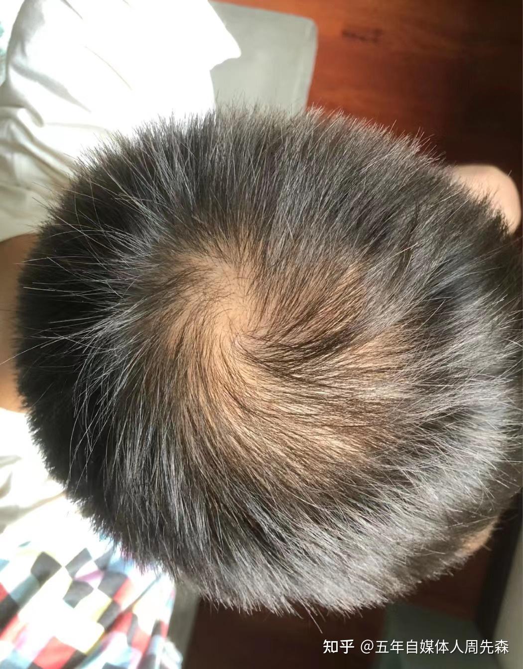 我是不是要秃了,怎么办啊! - 知乎