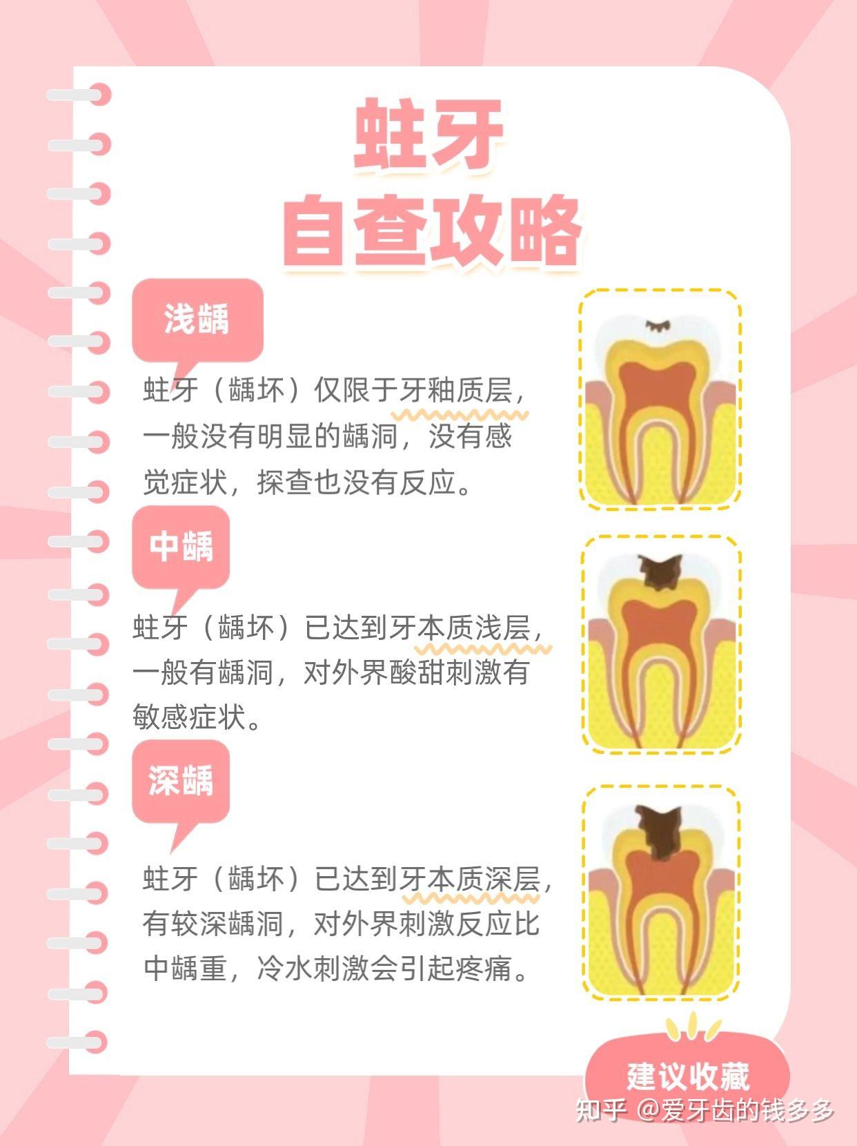 龋齿到什么程度需要补牙?补牙为什么要趁早? - 知乎