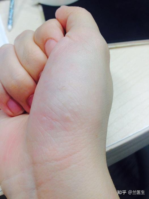 手掌握紧有刺痛感,起泡蜕皮,有不正常的红点(红点在皮肤下,不明显